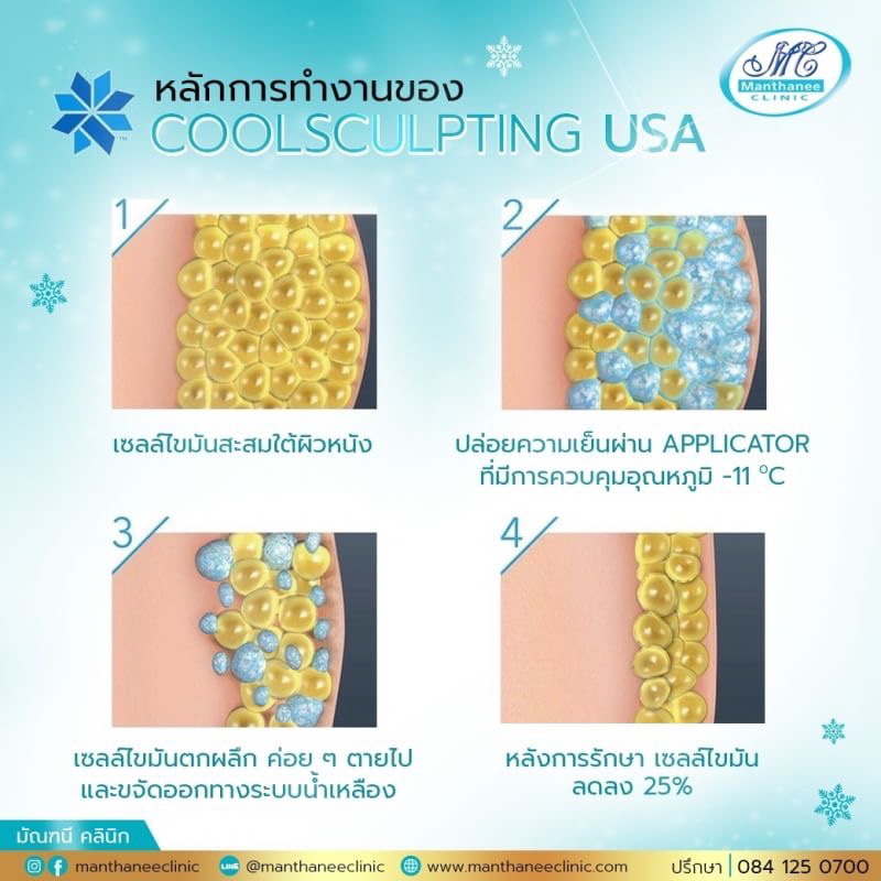 Tips to reduce specific points with Coolsculpting.